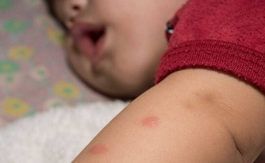 Effective Treatments To Cure Bug Bites In Babies